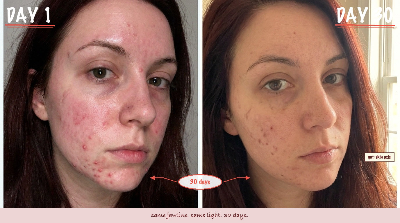 Day 1 to day 30: skin clearing, gut-skin axis